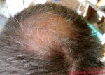 Haarausfall oberer Kopfbereich
